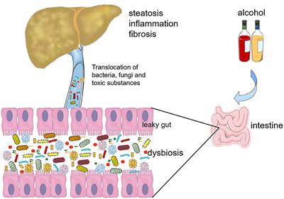 The Role of Gut Bacteria and Fungi in Alcohol-Associated Liver Disease